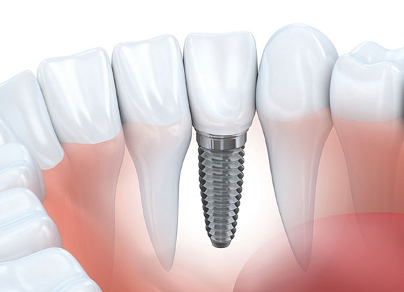 Dental Implants implants